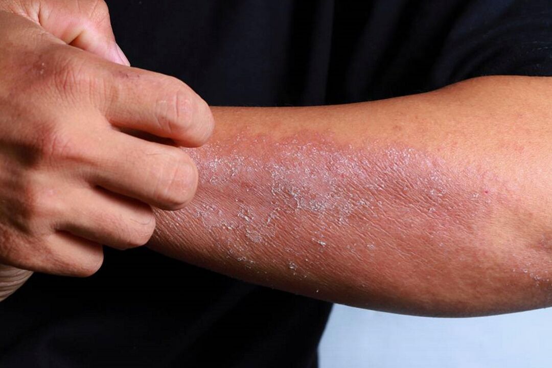 Psoriasis symptoms